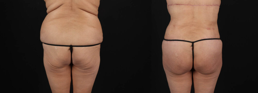 Post Bariatric Surgery (Massive Weight Loss) case #261401