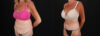 Post Bariatric Surgery (Massive Weight Loss) case #261861 slider thumbnail