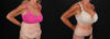 Post Bariatric Surgery (Massive Weight Loss) case #261861 slider thumbnail