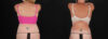 Post Bariatric Surgery (Massive Weight Loss) case #261861 slider thumbnail