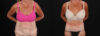 Post Bariatric Surgery (Massive Weight Loss) case #261861 slider thumbnail