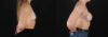 Breast Augmentation case #261355 slider thumbnail