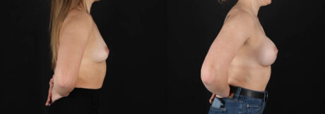 Breast Augmentation case #261355