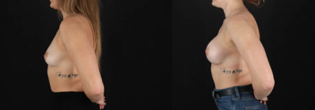 Breast Augmentation case #261355