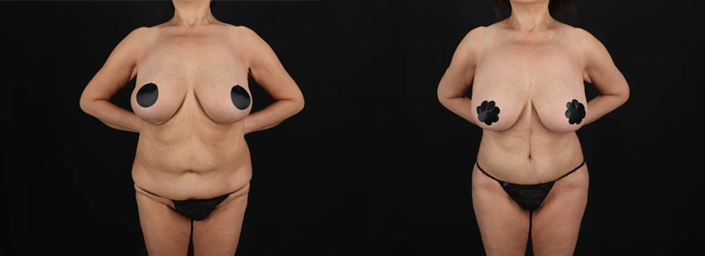 Post Bariatric Surgery (Massive Weight Loss) case #261401