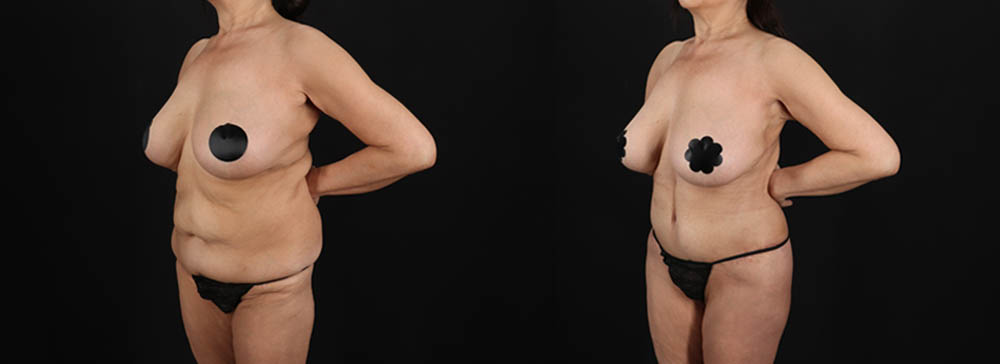 Post Bariatric Surgery (Massive Weight Loss) case #261401