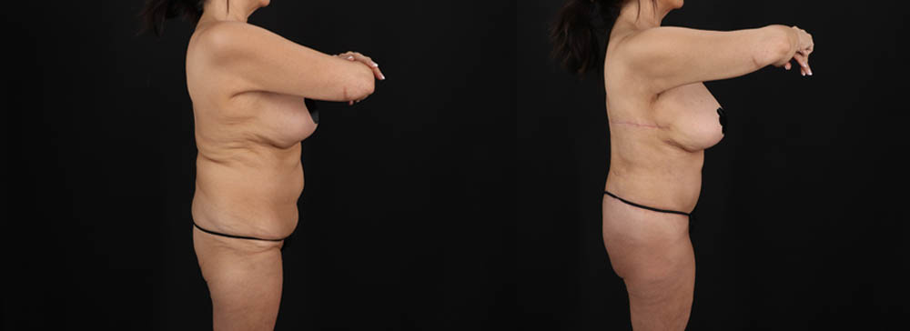 Post Bariatric Surgery (Massive Weight Loss) case #261401
