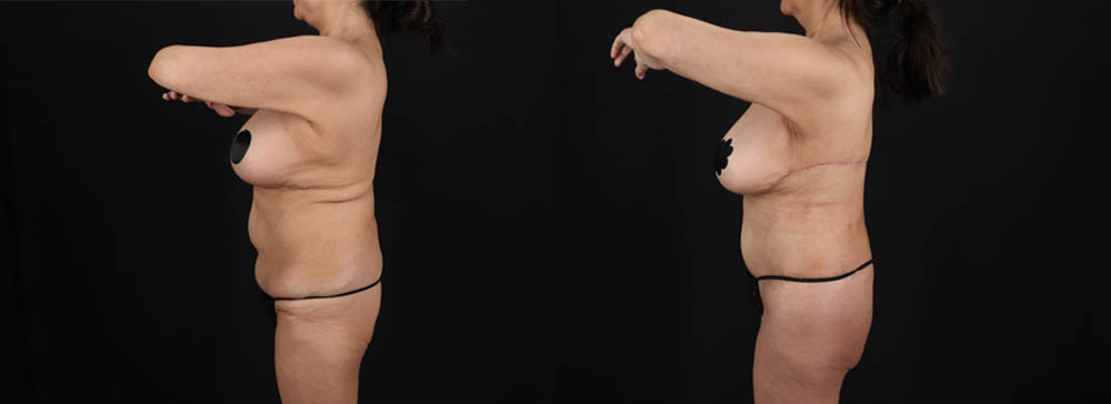 Post Bariatric Surgery (Massive Weight Loss) case #261401