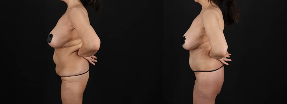 Post Bariatric Surgery (Massive Weight Loss) case #261401