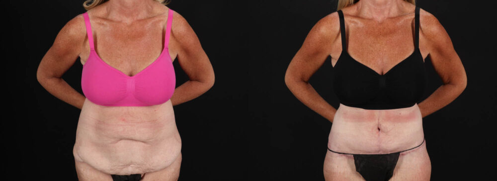 Post Bariatric Surgery (Massive Weight Loss) case #261861