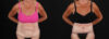 Post Bariatric Surgery (Massive Weight Loss) case #261861 slider thumbnail