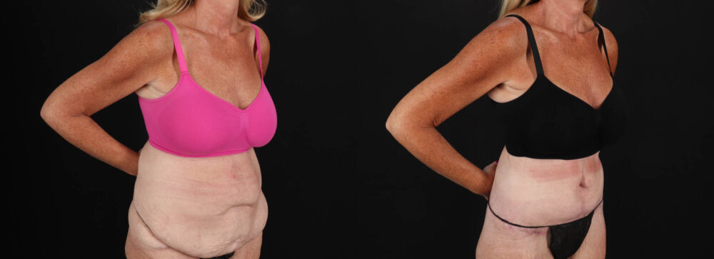 Post Bariatric Surgery (Massive Weight Loss) case #261861