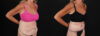Post Bariatric Surgery (Massive Weight Loss) case #261861 slider thumbnail
