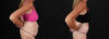 Post Bariatric Surgery (Massive Weight Loss) case #261861 slider thumbnail