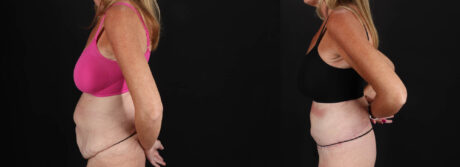 Post Bariatric Surgery (Massive Weight Loss) case #261861