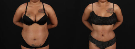 Tummy Tuck case #261849