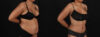 Tummy Tuck case #261849 slider thumbnail