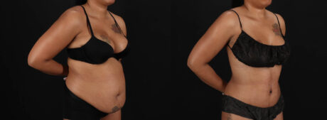 Tummy Tuck case #261849