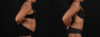 Tummy Tuck case #261849 slider thumbnail