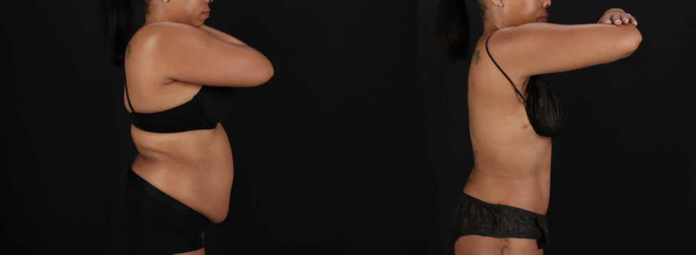 Tummy Tuck case #261849