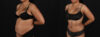 Tummy Tuck case #261849 slider thumbnail