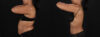 Tummy Tuck case #261849 slider thumbnail