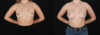 Breast Augmentation case #261355 slider thumbnail