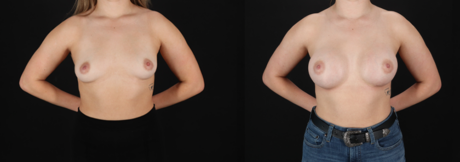 Breast Augmentation case #261355