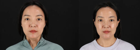 Botox® & Other Neuromodulators case #261333