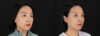 Botox® & Other Neuromodulators case #261333 slider thumbnail