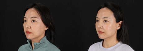 Botox® & Other Neuromodulators case #261333