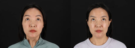 Botox® & Other Neuromodulators case #261333