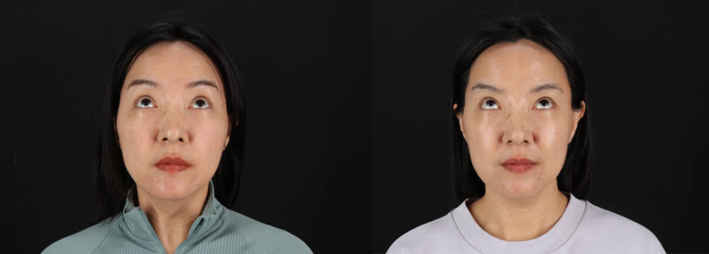 Botox® & Other Neuromodulators case #261333