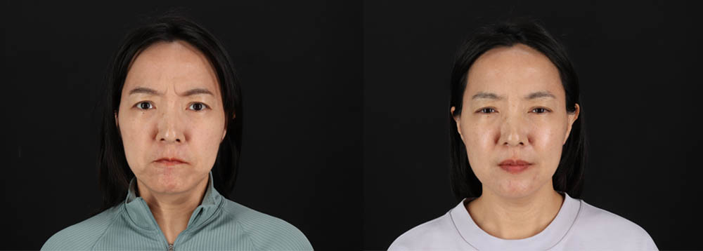 Botox® & Other Neuromodulators case #261333