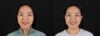 Botox® & Other Neuromodulators case #261333 slider thumbnail