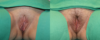 Labiaplasty case #261858 slider thumbnail