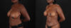 Mommy Makeover case #261346 slider thumbnail