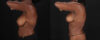 Mommy Makeover case #261346 slider thumbnail