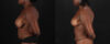 Mommy Makeover case #261346 slider thumbnail