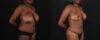 Mommy Makeover case #261346 slider thumbnail
