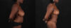 Mommy Makeover case #261346 slider thumbnail