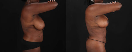 Mommy Makeover case #261346