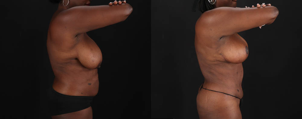 Mommy Makeover case #261346