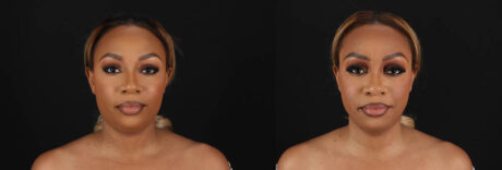 Submental Liposuction case #261395