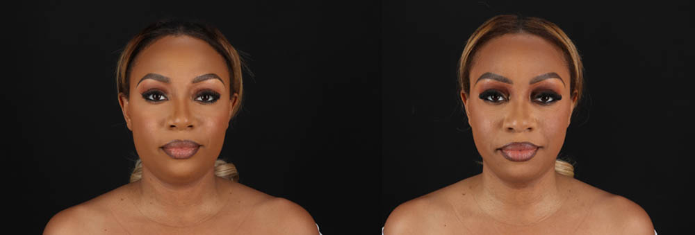 Submental Liposuction case #261395
