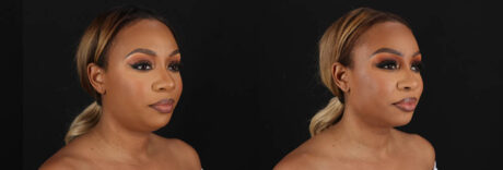 Submental Liposuction case #261395