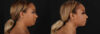Submental Liposuction case #261395 slider thumbnail