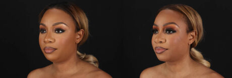 Submental Liposuction case #261395