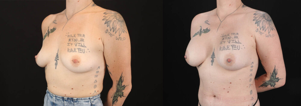 Breast Augmentation case #263023