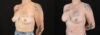 Breast Augmentation case #263023 slider thumbnail